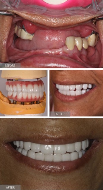 NYC Dental Implants Center Manhattan East Side, NY 10065